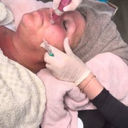 Microneedling Online Schulung -  Professionelle Hauterneuerung Schritt für Schritt