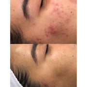 Microneedling